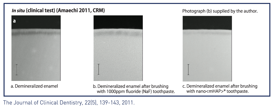 pictures showing difference between demineralized tooth and remineralized with nano mhap
