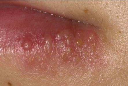 mouth with herpes