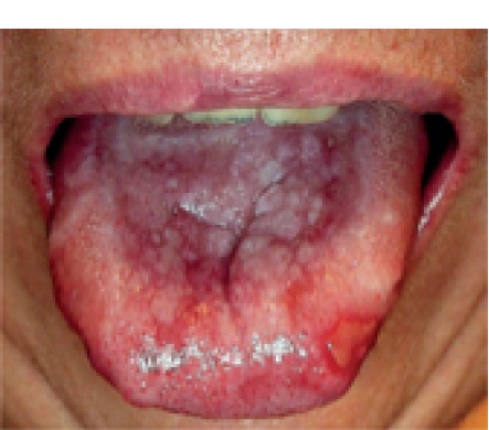 tongue with lesions