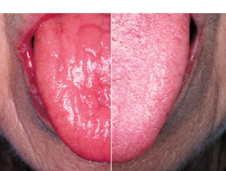 tongue split in two showing a healthy and unhealthy side